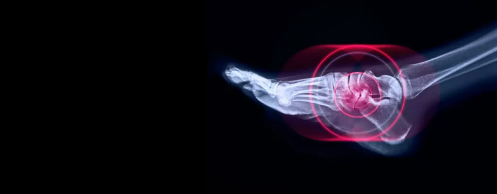 Science of Arthritis Pain Mechanisms